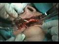 UEPB - CIRURGIA DE DENTE INCLUSO - ADULTO