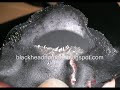http://blackheadnomore.blogspot.com

This is the real art of extracting blackheads & how to get rid of blackheads. Squeezing will cause infection & scars. Pore strips don't work. Scrubbing won't help. 

The only cure that has worked so well for me & my customers ... is The BLAKhead Masque!

This video is taken to show you that it really works!! Worked for me & now for many of my clients!! I use it twice a week & now I've got less blackheads to extract !

To buy this product, go to the link above & click 'Buy Now' at the right column.