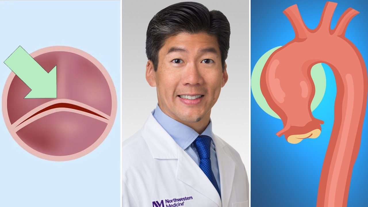 Surgeon Q&A: Bicuspid Aortic Valves, Connective Tissue Disorders & Aneurysms
