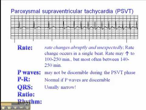 how to treat junctional tachycardia