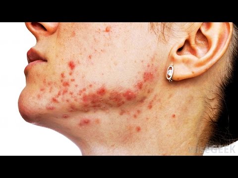 how to lighten acne marks