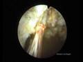 HPS Green Light Laser Teil 2