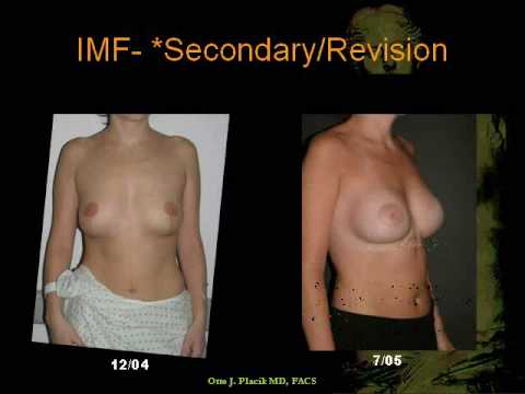 puffy breast