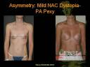 Breast Asymmetry Part 3/4