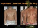 Breast Asymmetry Part 3/4