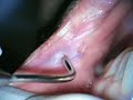 Hemangioma Removal with PerioLase Nd:YAG laser
