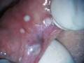 Hemangioma Removal with PerioLase Nd:YAG laser