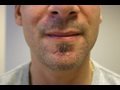 The Acne Practice  (Home Version 10 -- perioral)