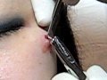 Microdermal piercing eltávolitás ezt ne nézd meg !!! - Removing my cheek microdermal