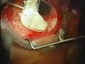 Ahmed Valve Surgery for Glaucoma PART1