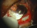 Ahmed-Valve-Surgery-