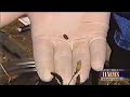 Forensic Entomology