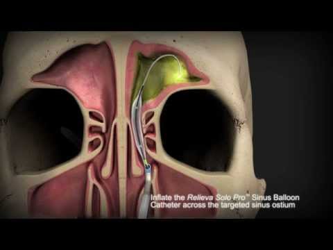 how to relieve frontal sinus pressure