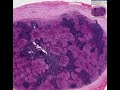 Histopathology Lymph node--Langerhans cell histiocytosis (Ha