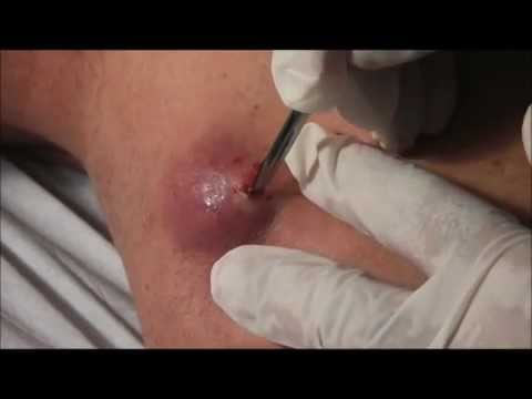how to drain a cyst