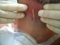 spider bite cyst boil zit pimple explosion