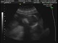 3D Ultrasound 1-28-2006