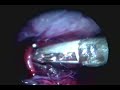 Laparoscopic Varicocelectomy