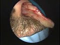 Inverting Papilloma