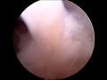 ACL surgery 1/6
