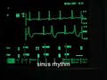 extrasystoles (ventricular bigeminus)