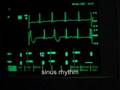 extrasystoles (ventricular bigeminus)