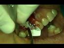 Dental Implant Video preview 01