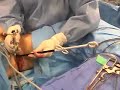 laparoscopic myomectomy