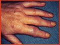 Artritis reumatoide (reportaje)