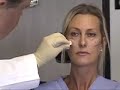 Cheek Augmentation  Juvederm