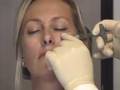 Cheek Augmentation  Juvederm