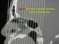 How To Read CT Sinus Scans Like An Expert