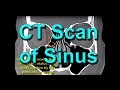 How To Read CT Sinus Scans Like An Expert