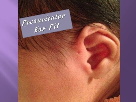 how to drain preauricular pit