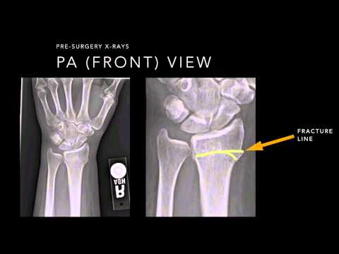 how to know fracture in x-ray