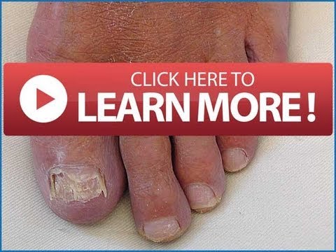 how to cure onycholysis