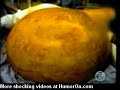 woman-has-a-300-pound-tumour-removed-from-her-stomach.html