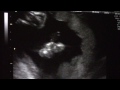 Ultrasound Week 15 Video