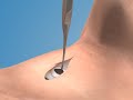 Surgical Cricothyrotomy Surgical Cricothyrotomy