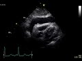RV diastolic collapse in tamponade