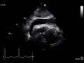 RV diastolic collapse in tamponade
