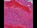 Histopathology Liver--Traumatic hemorrhage Histopathology Liver--Traumatic hemorrhage