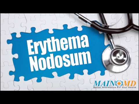 how to treat erythema nodosum