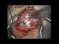Microsurgical Resection of a Brain Tumor
