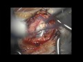 Brain Tumor Microsurgical Resection Brain Tumor Microsurgical Resection