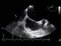 videos de TEE RA pectinate muscle