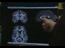 Life With VCFS Part 2 Velocardiofacial Syndrome