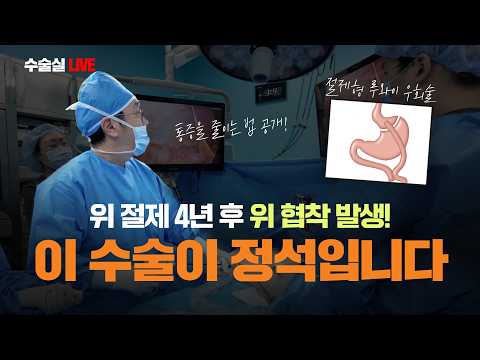 위소매절제술(비만대사수술) 4년 후 생긴 위협착으로 인한 재수술, 이 수술..