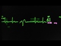 ventricular extrasystoles, with R on T phenomenon on an ECG monitor