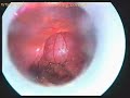 Intramural-appendix-